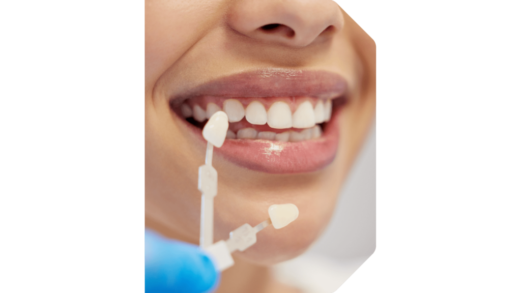 Studio Dentistico Dentit - Eccellenze - Faccette dentali a Milano