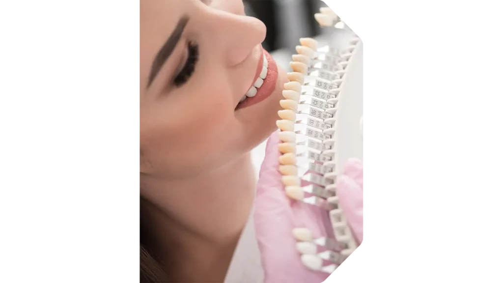 Faccette dentali a Milano - Studio Dentistico Dentit